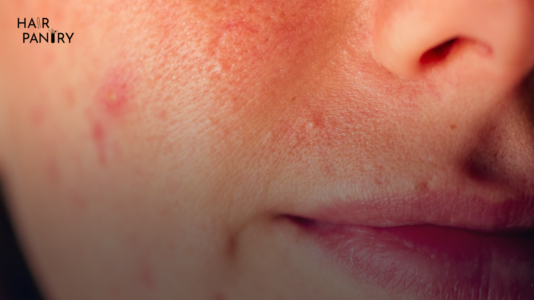 How to Remove Acne and Marks from Your Face