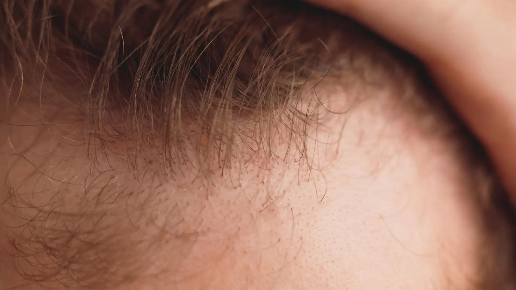 DHT and Androgenic Hair Loss: Why Your Hairline Is Receding in Your 20s
