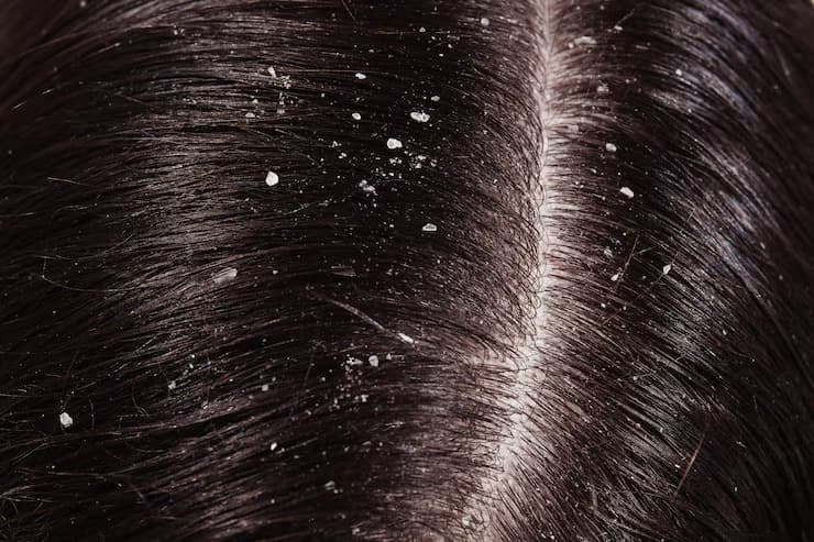 Dandruff vs Dry Scalp: How to Tell Which One You Have