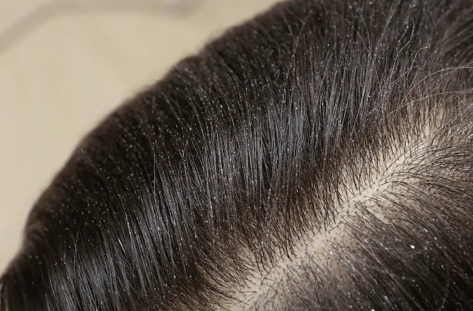 woman with dandruff in her dark hair closeup