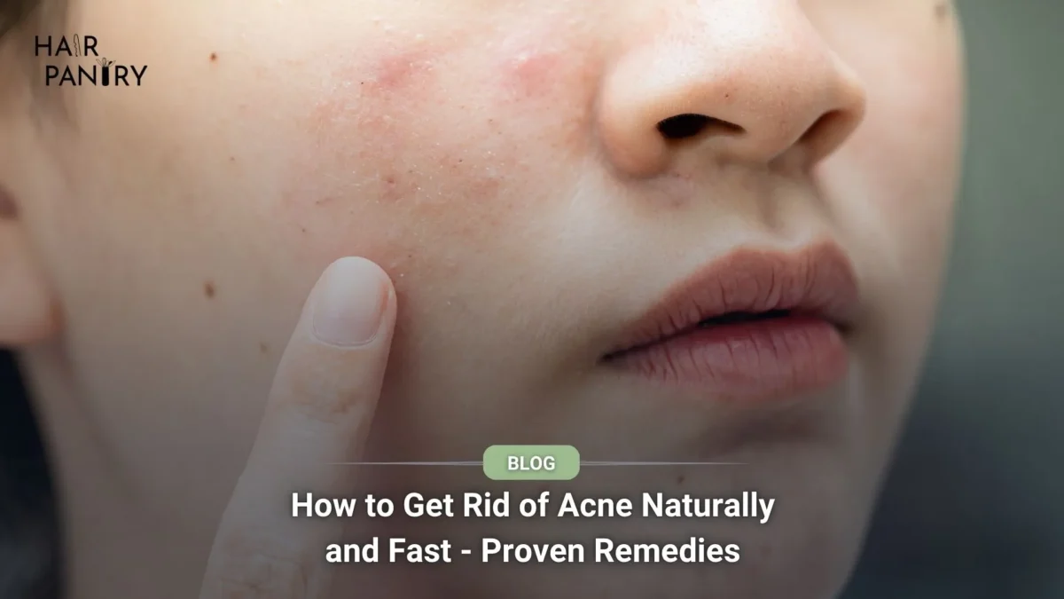 How to Get Rid of Acne Naturally and Fast - Proven Remedies