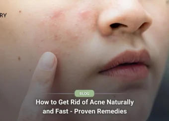 How to Get Rid of Acne Naturally and Fast - Proven Remedies