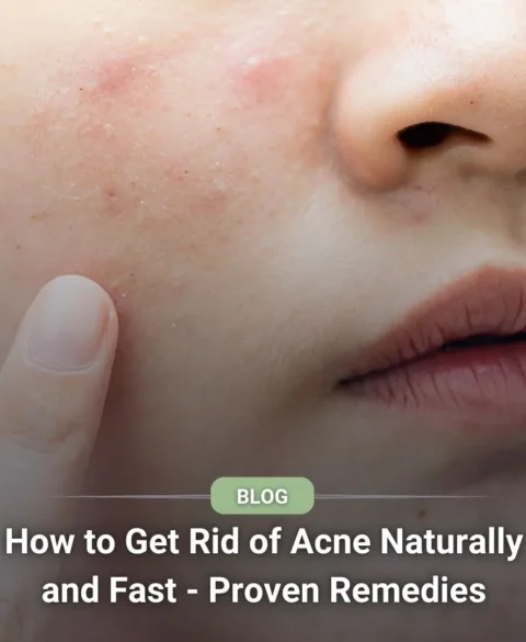 How to Get Rid of Acne Naturally and Fast - Proven Remedies