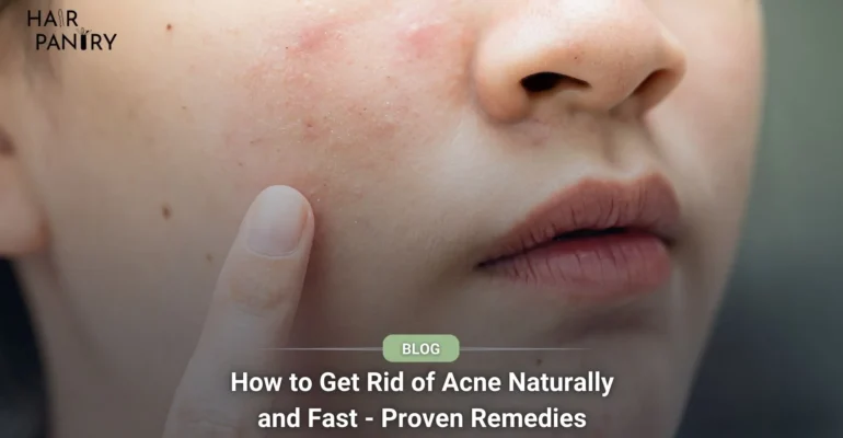 How to Get Rid of Acne Naturally and Fast - Proven Remedies