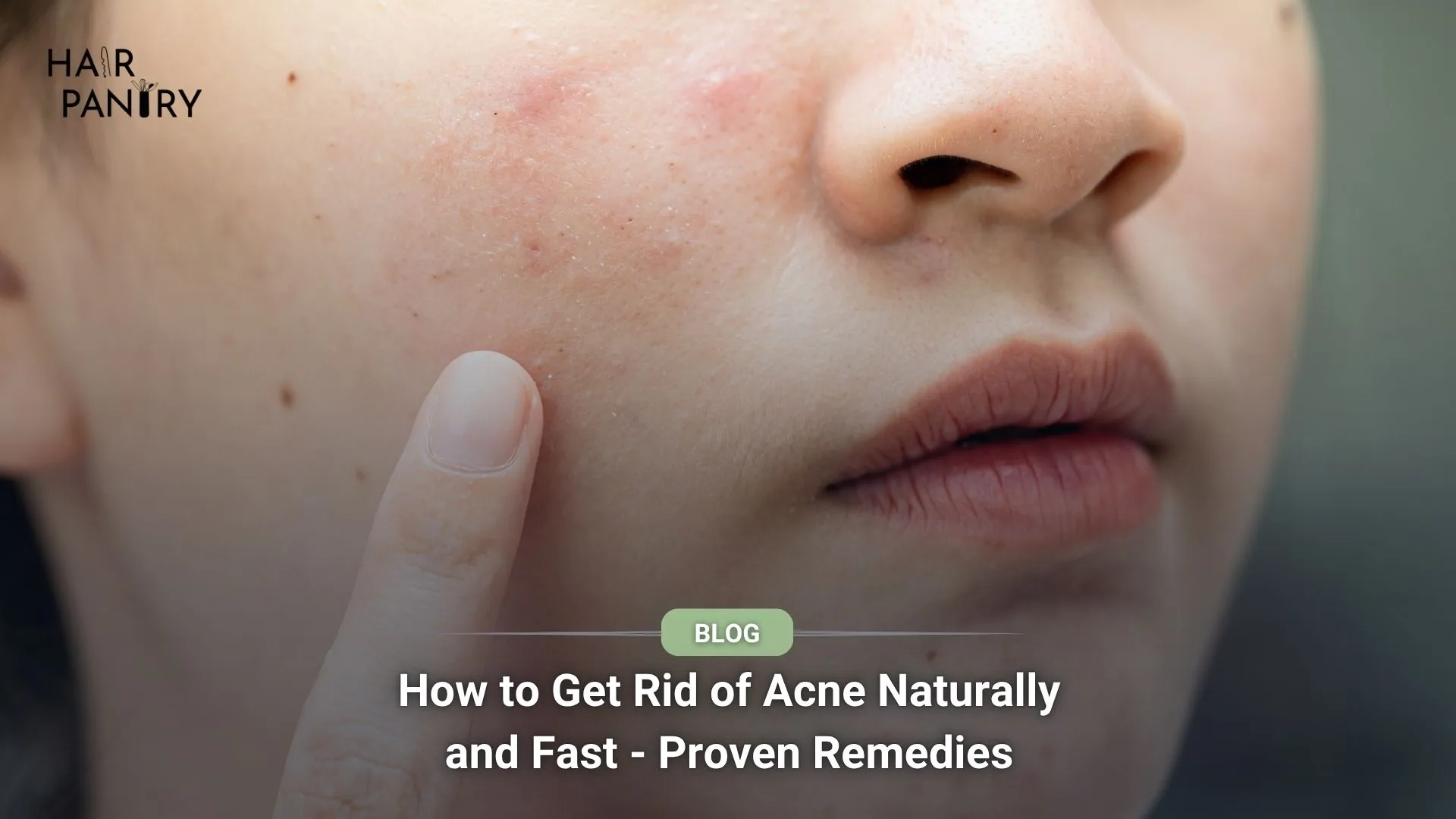 How to Get Rid of Acne Naturally and Fast - Proven Remedies